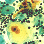 Πυρηνες με φαινόμενο θολού γυαλιού